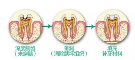 补了几个月的牙为什么又痛了,三年前补过的牙又疼了是什么原因