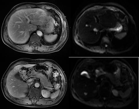 放疗局控百分百：鼻咽癌肝转移化疗联合免疫治疗失败后