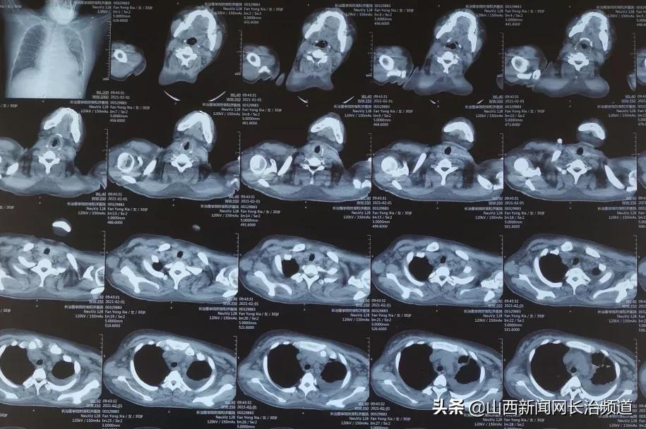 “与狼共舞”不再是梦——长治医学院附属和济医院肾内科救治一例肾衰竭合并脑出血患者