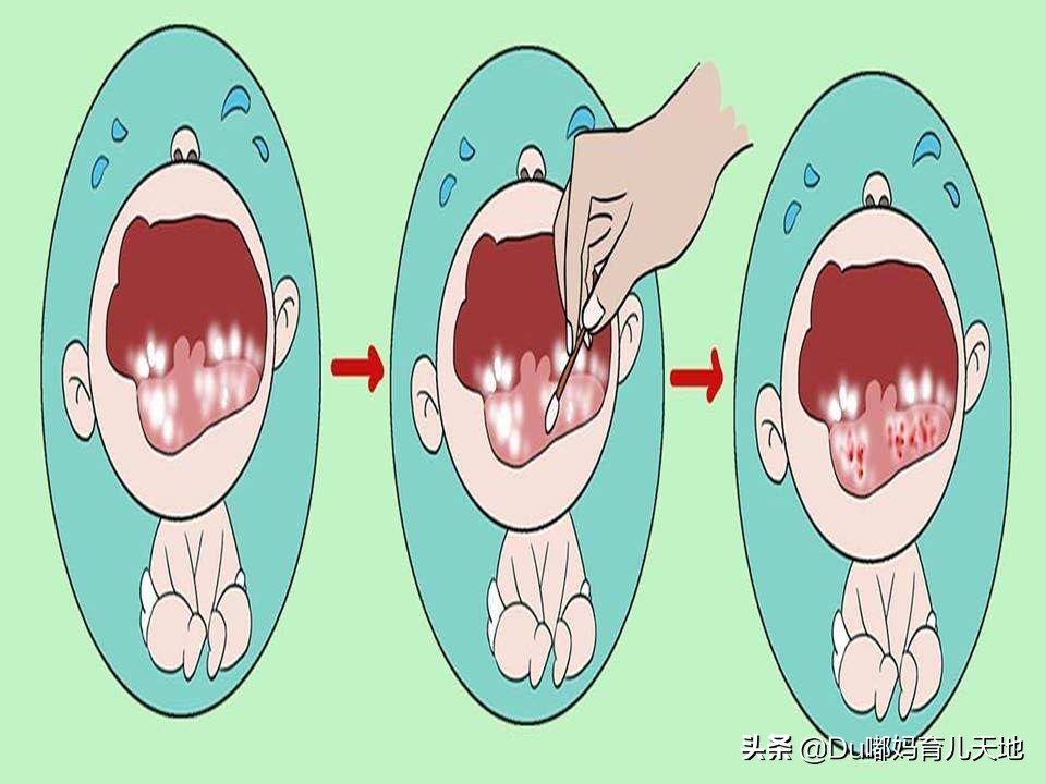 鹅口疮能自愈吗鹅口疮怎么治,什么是鹅口疮啊