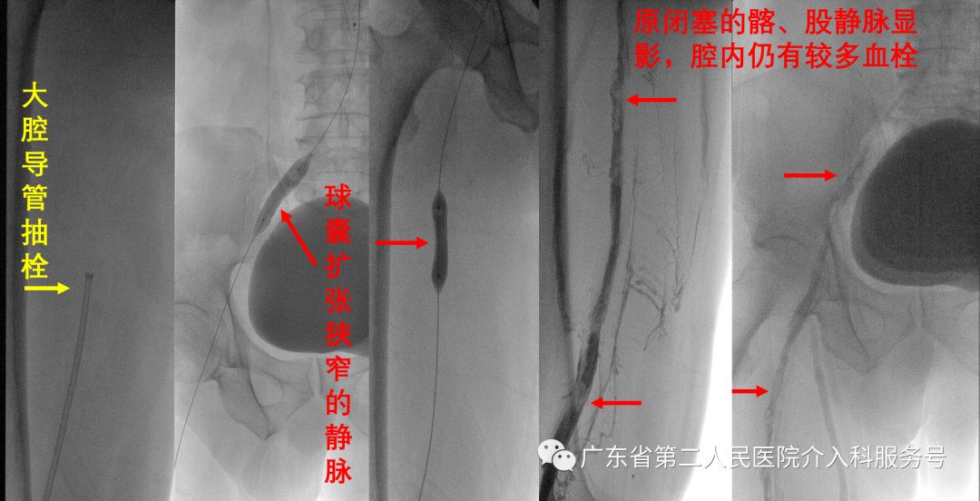 左腿血栓的最快消除方法,左腿浮肿有血栓用什么药治疗