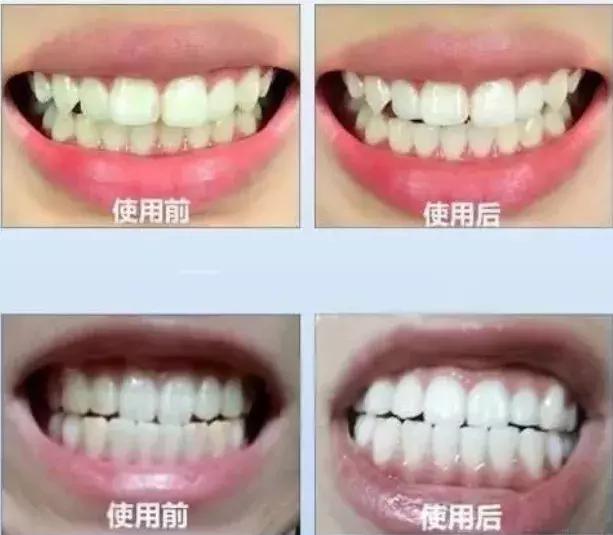 网红爆款美牙仪新科技,网红用的美牙仪有用吗