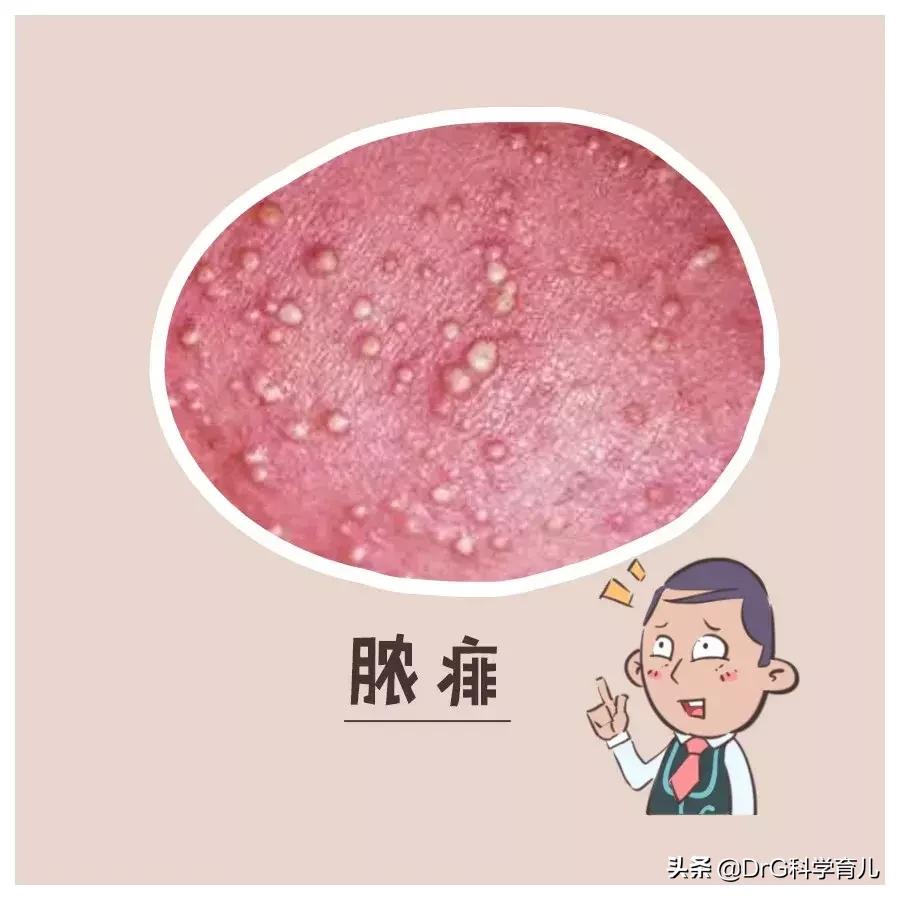 天气热了长痱子怎样快速解决,天热身上起痱子有特效药吗