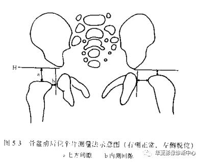 先天性髋关节脱位截骨术全过程,先天性髋关节脱位可以考驾驶证吗