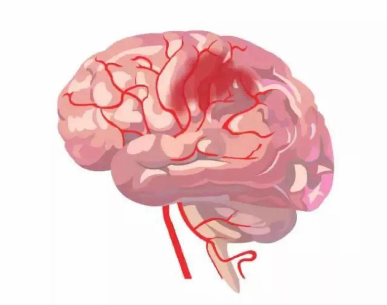 今日故事最新视频,今日头条有关脑梗的文章