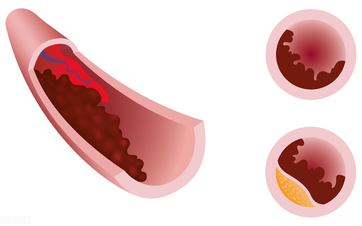 谈栓色变?血“栓”其实是个双刃剑,具体干预很关键
