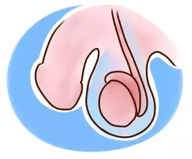 男孩“蛋疼”3天被切除，妈妈多做一件事就能避免的！