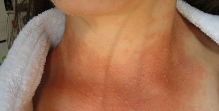 念珠菌的预防方法,念珠菌怎样预防