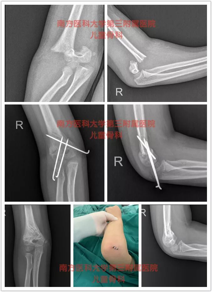 小孩胳膊骨折的治疗方法,胳膊骨折后骨折处发热怎么回事