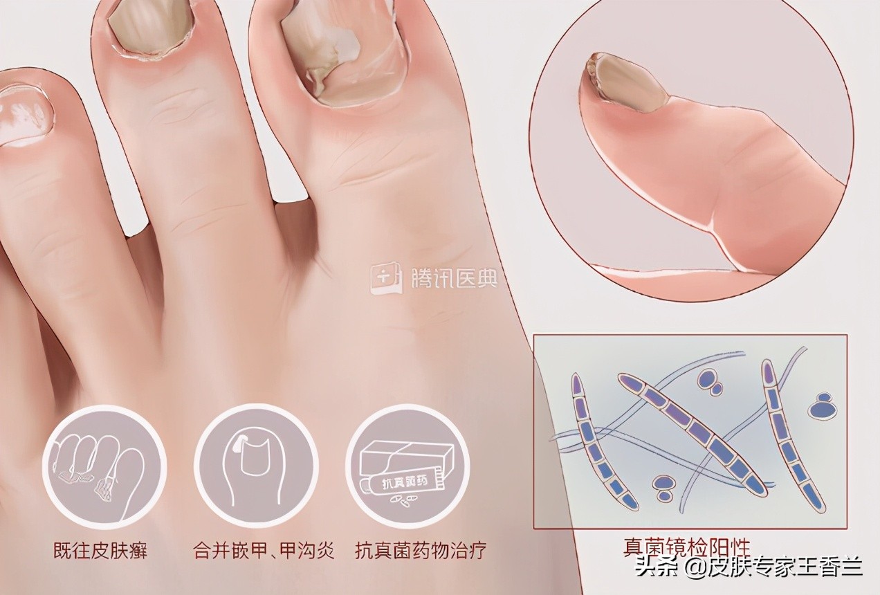 天气热就出来的癣是什么,天气变暖身上就起癣是怎么回事