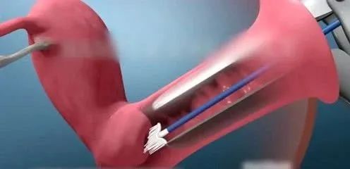 宫颈癌筛查是取哪些东西,宫颈癌筛查需要准备什么