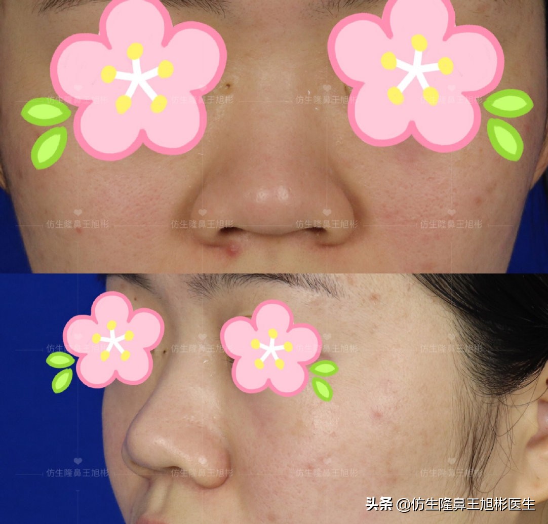 隆鼻鼻头大是失败了吗,大鼻头隆鼻手术案例