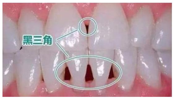 牙齿矫正，你后悔了吗？