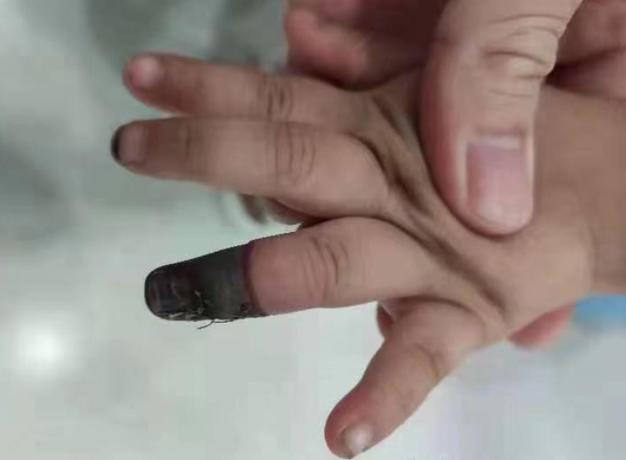 三岁女童手指被压断后续,小孩手指被夹伤需要多久才能恢复