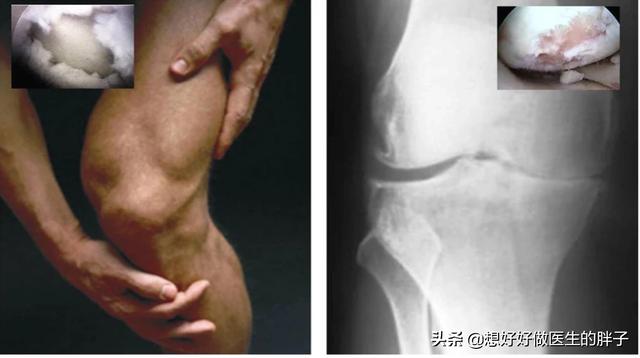 医院发现有骨刺怎么办,膝盖骨刺的正确处理方法视频