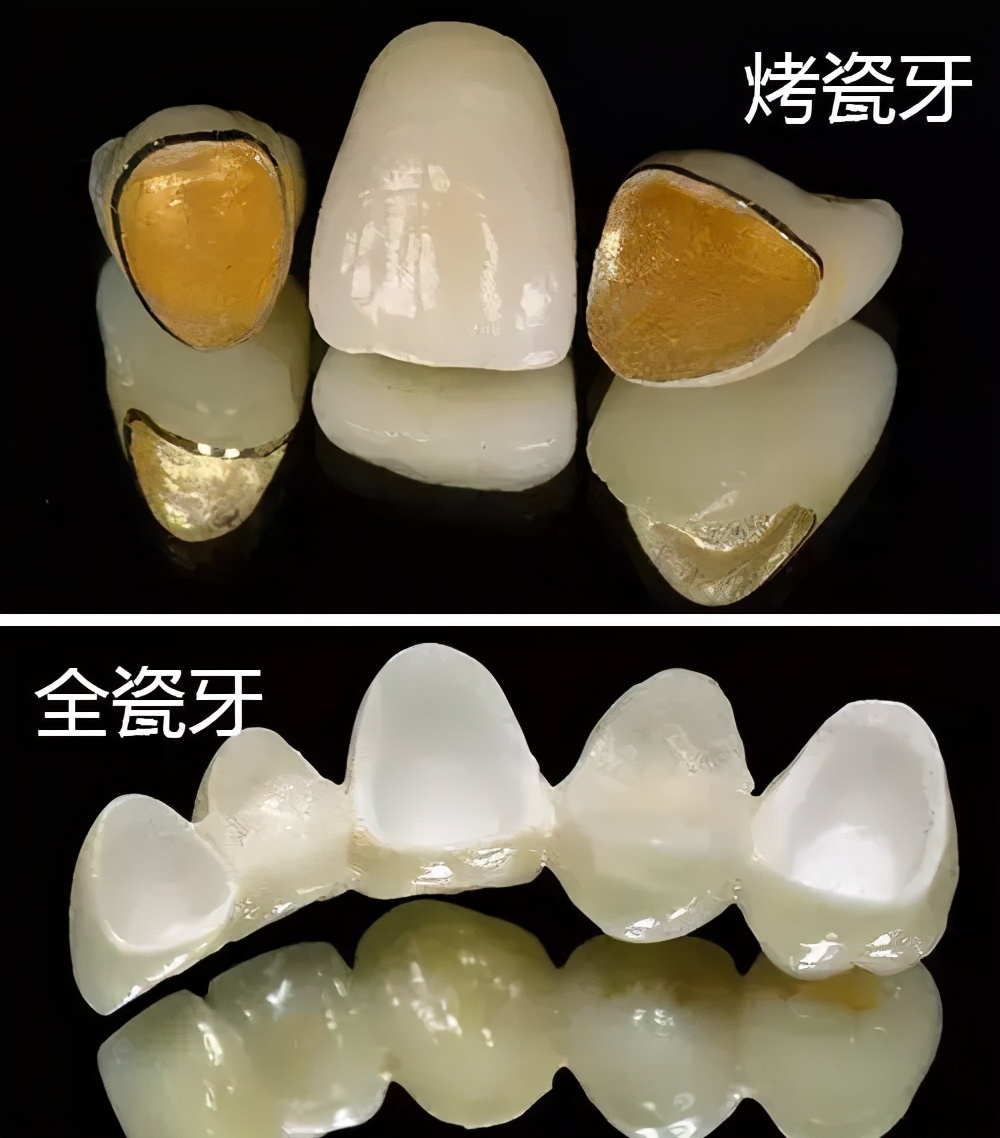 烤瓷牙基底冠如何清洁不崩瓷,烤瓷牙咬合面崩瓷必须重做吗