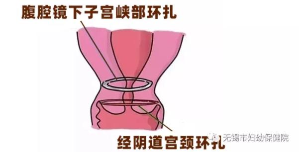 宫颈环扎感染早产,预防早产可以宫颈环扎术吗