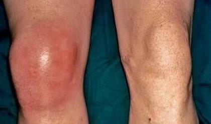 膝盖有滑膜炎，还能治愈吗？该怎么办？不想手术，3个要点需牢记