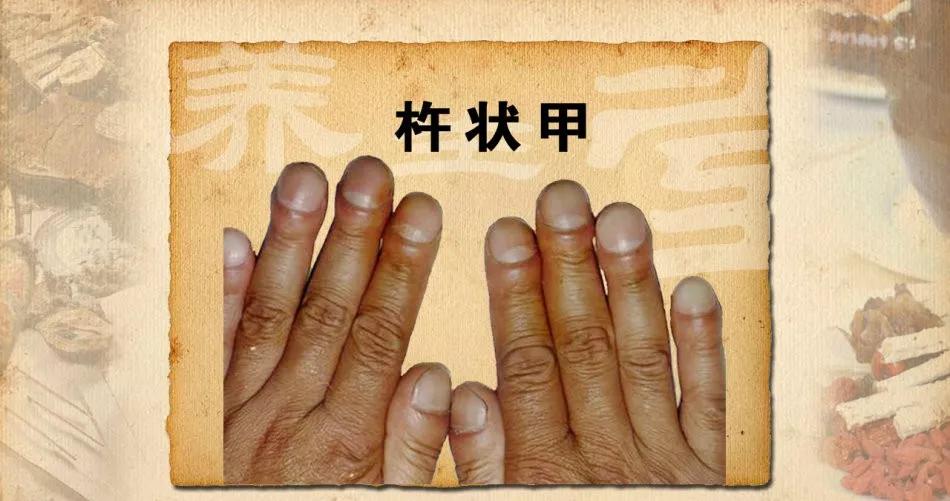 身体好不好,看手就知道!这几处变化可能藏大病