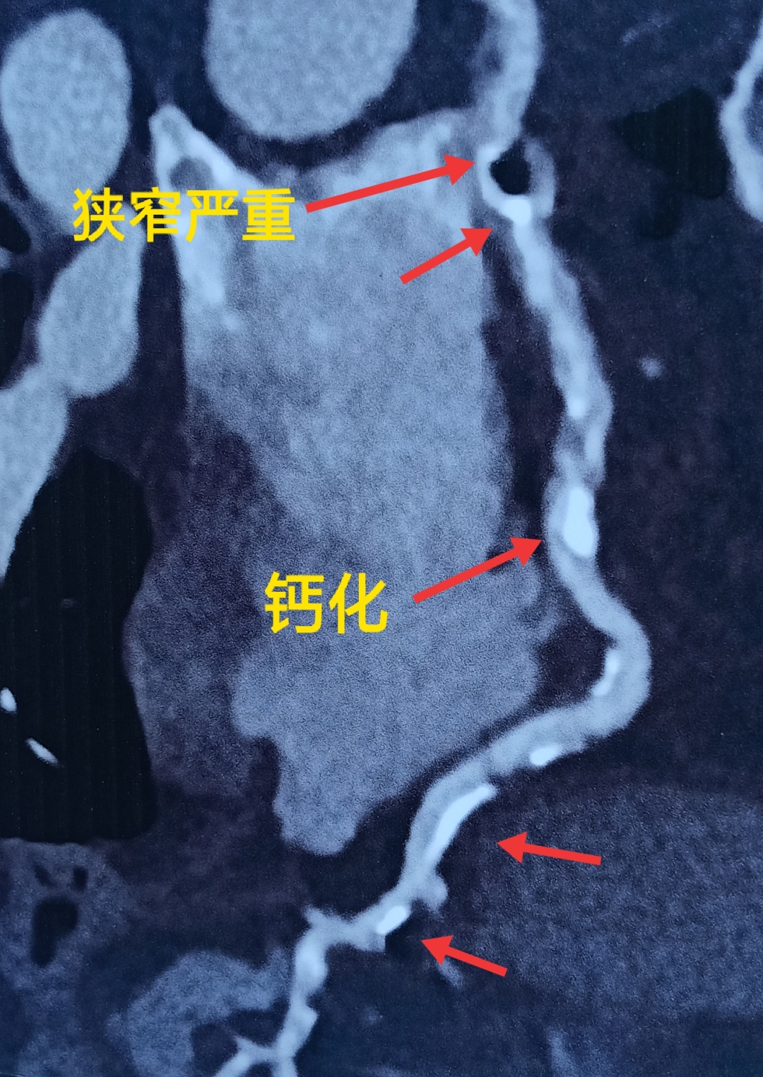 70岁老人心口疼能保守治疗吗,60岁老人心口疼是怎么回事