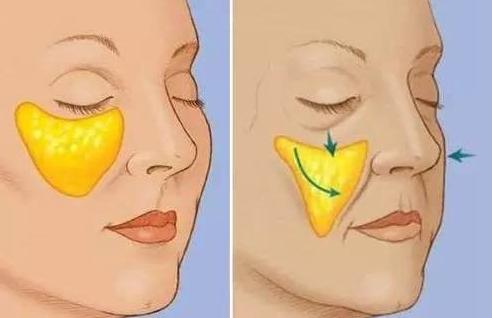 法令纹苹果肌下垂有什么办法改善,如何改善法令纹和苹果肌下垂