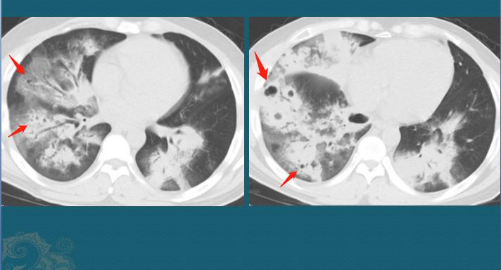 流感合并细菌感染好治疗吗,流感病毒肺炎怎么治疗