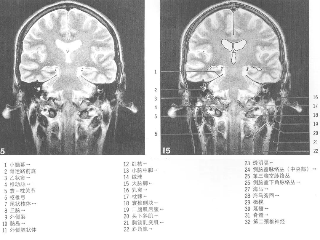 颅脑冠状状切面解剖图,颅脑mr解剖结构图