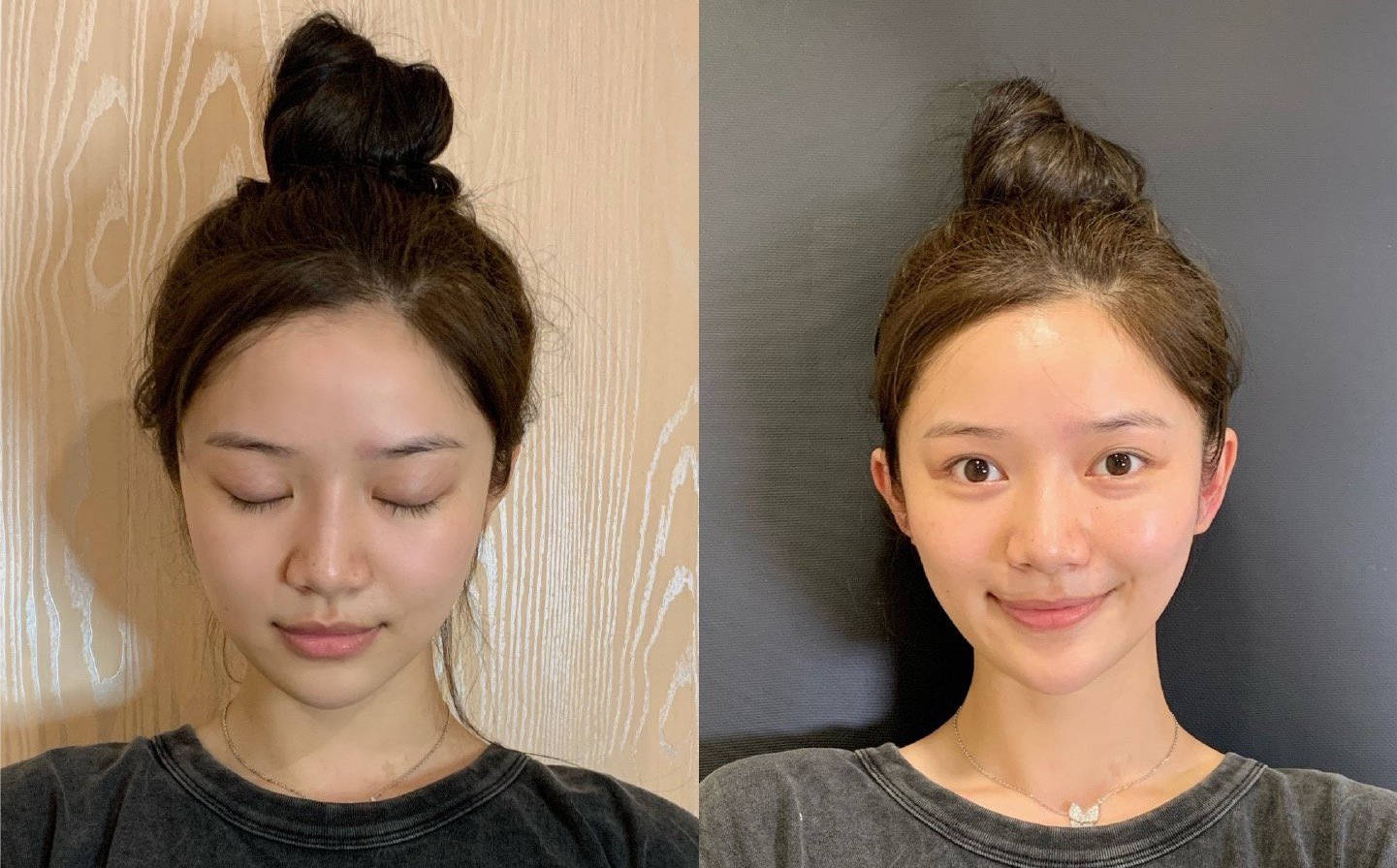 精灵耳可以弱化颧骨高颧弓宽吗,精灵耳下颌缘提升