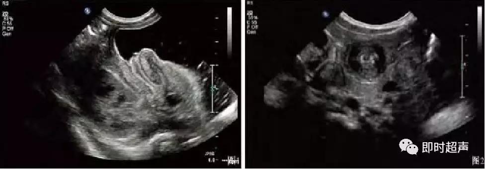 小儿消化道急症超声