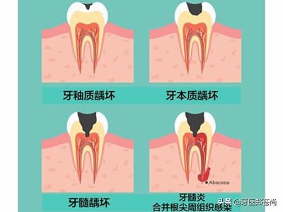 蛀牙疼得厉害直接拔掉行吗,智齿蛀牙烂了洞很疼能拔掉吗