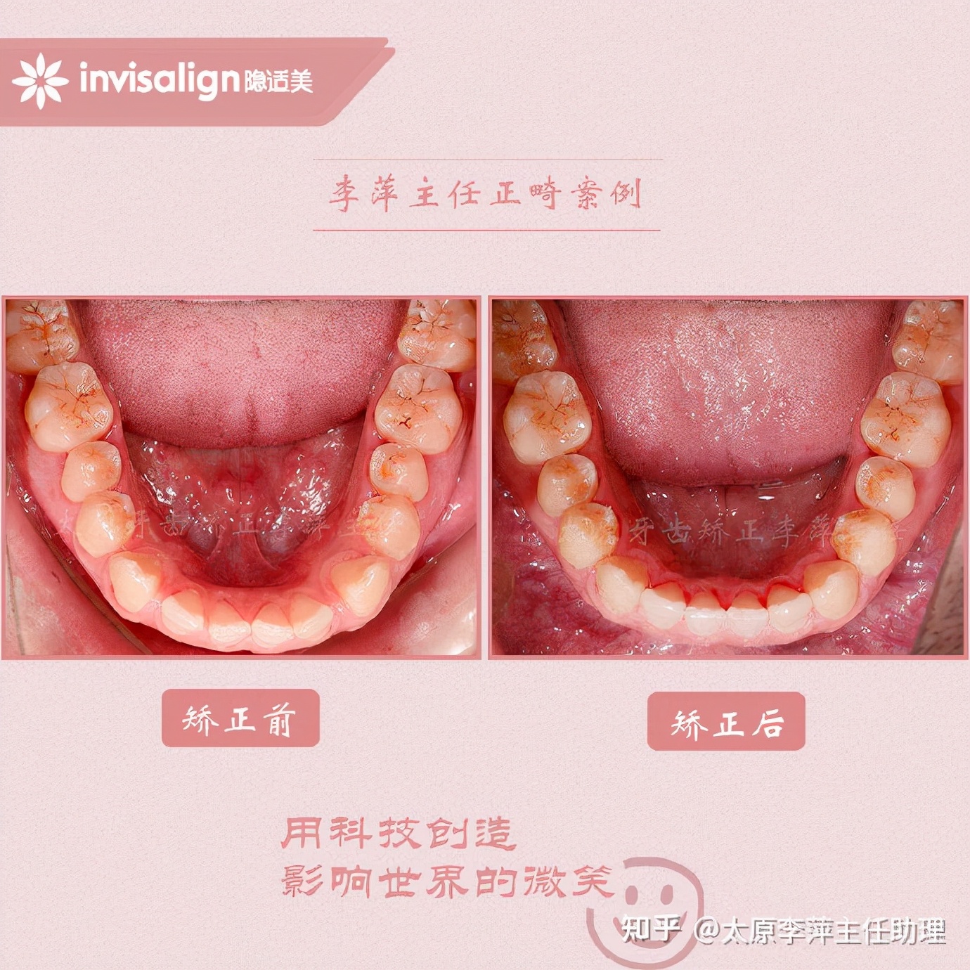 重度拥挤矫正牙齿适合隐形牙套吗,广州成人牙齿矫正推荐隐形牙套