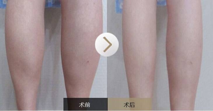 瘦腿针可以改善腿型么,瘦腿针成功的概率大吗