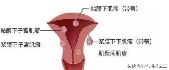 子宫出血、尿频和尿痛、月经增多，警惕得了子宫肌瘤的5大症状