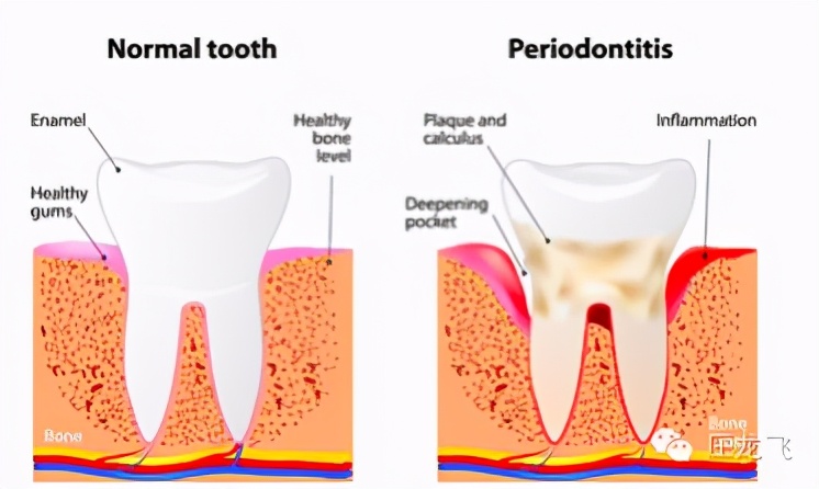 牙周炎是细菌导致的还是牙结石 (牙周炎是由一种细菌微生物引起的)