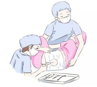 无痛分娩和剖腹产是一回事吗,打无痛分娩有副作用吗