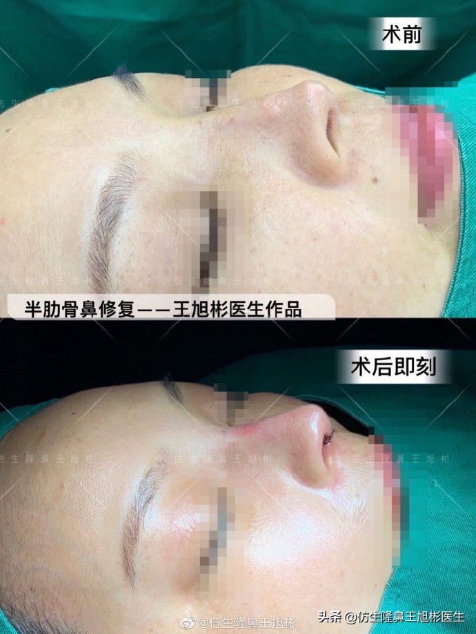 不想鼻子变得坑坑洼洼,不想整容想让鼻子挺起来