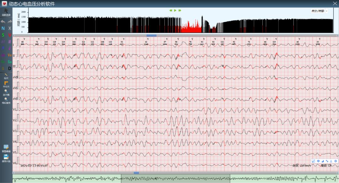埃里克森晕倒做了什么样的手术,埃里克森植入的是全皮下icd吗