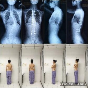 北京青少年脊柱侧弯矫正最佳方法,北京脊柱侧弯校正