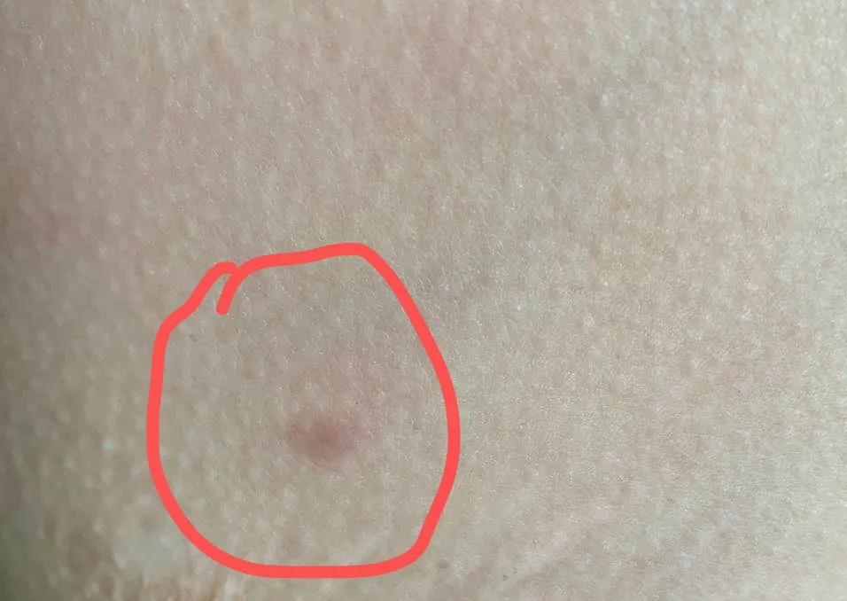 乳腺结节开刀经历几个阶段,乳腺结节切了是不是就治愈了呢