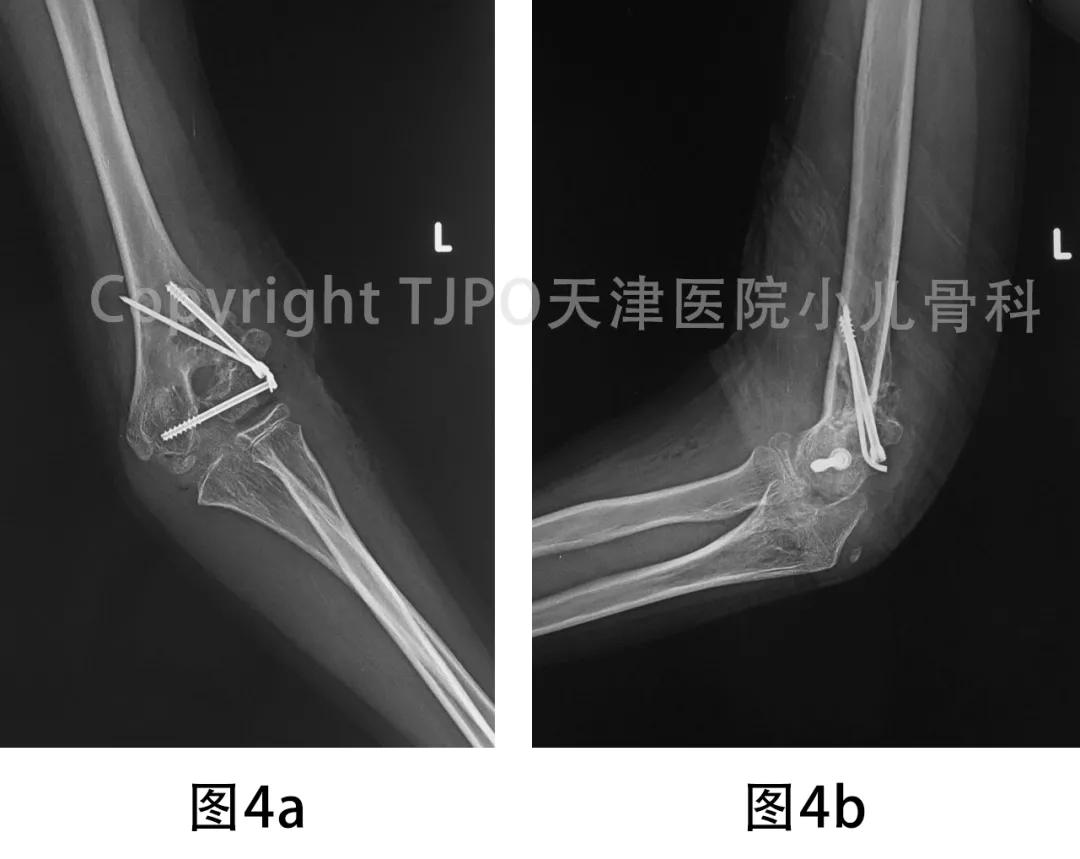 肱骨髁上骨折如何预防肘外翻畸形,肱骨髁上骨折外翻畸形原因