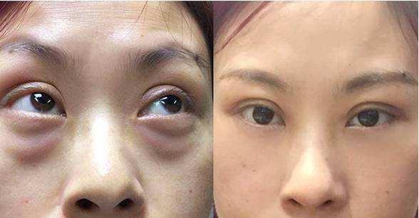 眼袋跟卧蚕的区别对比图,眼袋和卧蚕和黑眼圈的区别的图片