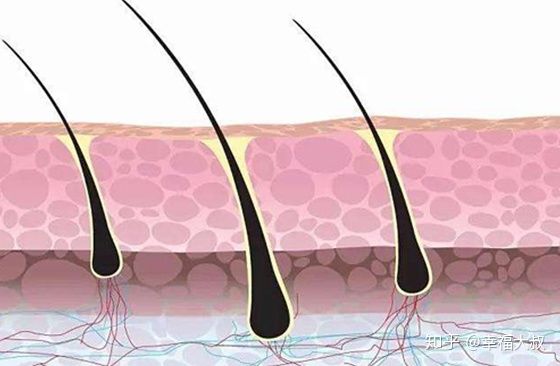 脱发性毛囊炎导致毛囊萎缩,毛囊萎缩脱发是什么样子
