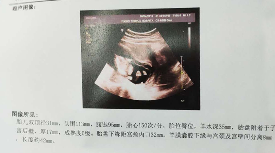 怀孕之路历经坎坷,熊猫血妈妈产检日常