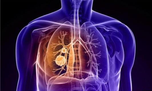 肺癌患者最后都是怎么离世的,肺癌一般是怎么死的