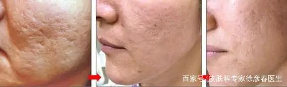 面部生疮后的瘢痕怎么办,疱疹后遗症怎么治