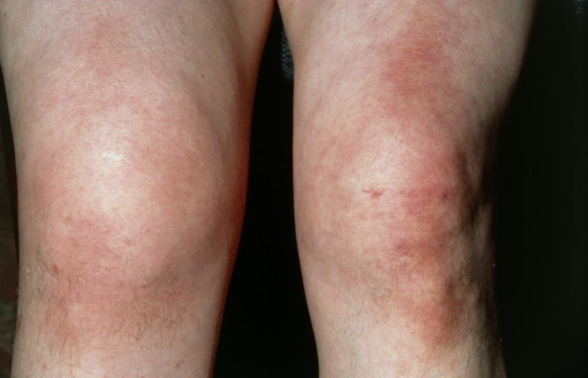 关节僵硬疼是湿气重的表现,关节湿气重是怎么回事