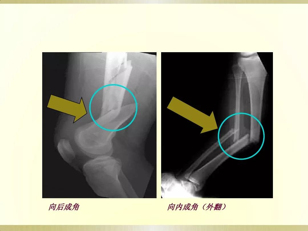 骨科x光片读片技巧,放射科骨科读片教程