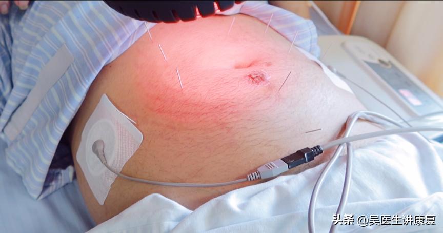 股骨头坏死植骨康复案例,股骨头康复后感悟