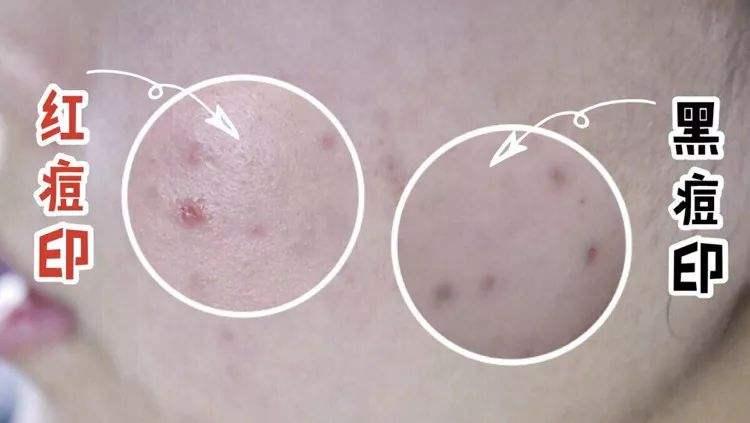 青春“悔恨”痘印该如何解决？详细解决方法全解答，不再“作死”