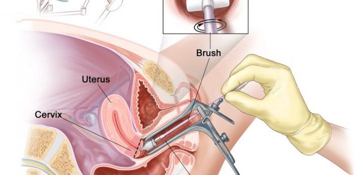 体检查出hpv是骗人的吗,体检时做的hpv筛查有可能误诊吗